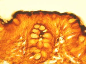 F,52y. | spirochetosis … colon Warthin-Stary silver impregnation F,52y. | spirochetosis … colon Warthin-Stary silver impregnation